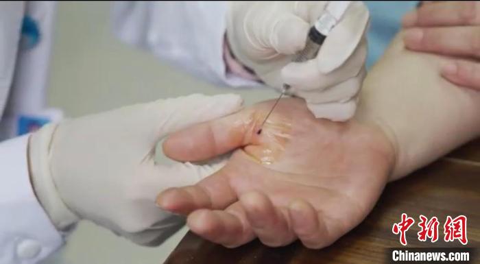 嘉善群眾體驗小針刀?！〖紊平y戰(zhàn) 供圖