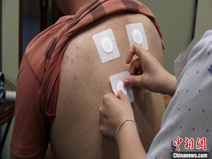 圖為醫(yī)生正在為民眾貼“三伏貼”?！√莆登?攝